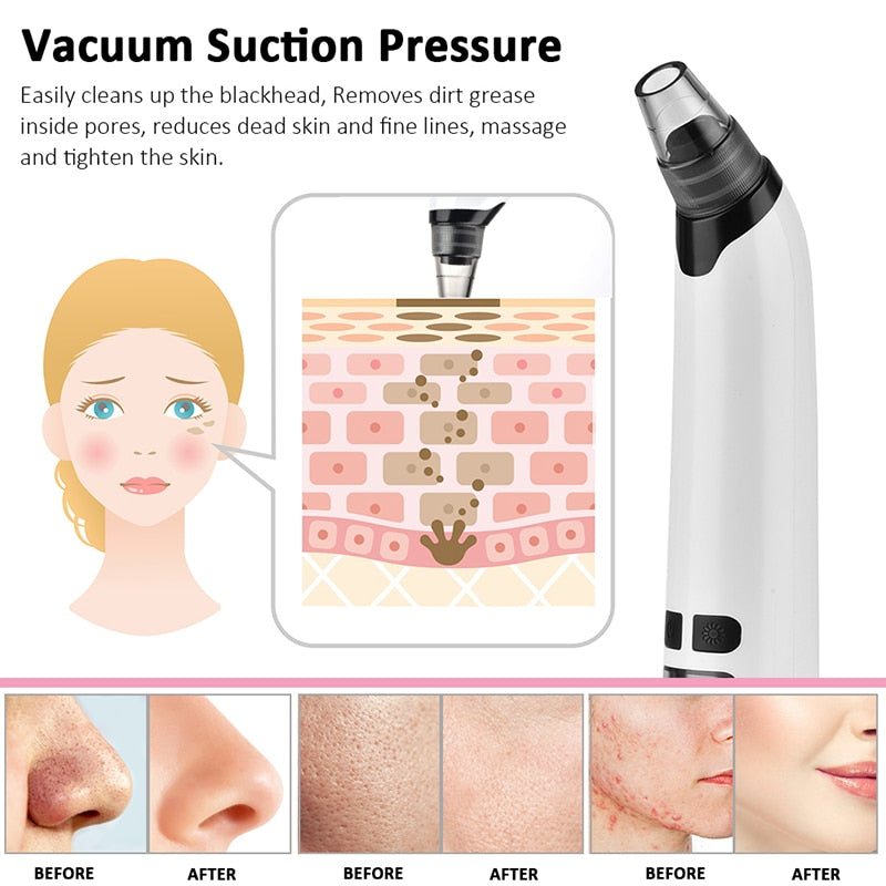 JoyPretty® Electric Blackhead Remover tool - Deep Pore Facial Cleaner for Black heads, Whiteheads, Acne Removal Joy Pretty Skin